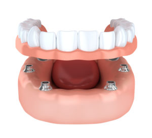 Replace your missing teeth with dental implants in Fort Lauderdale.