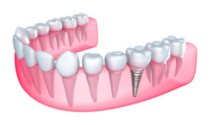 dental implant drawing