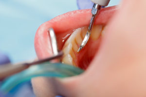 dental cleaning close up 