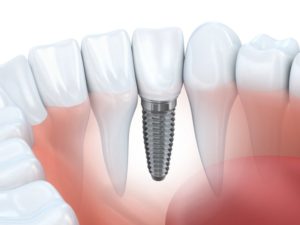 An illustration of a dental implant.