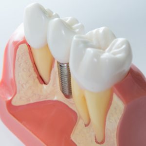 model of dental implant